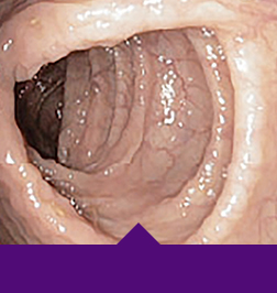 Endoscopic improvement